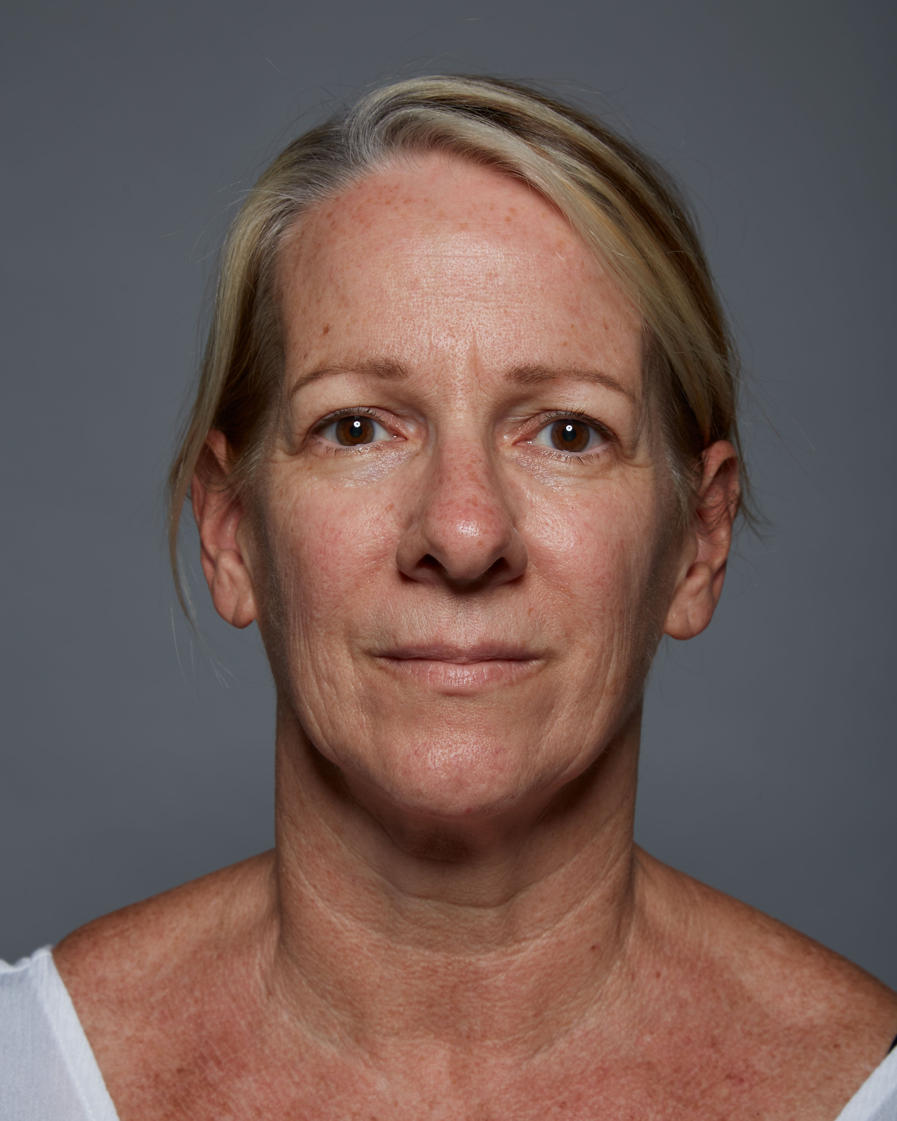 "Before" headshot of a clinical subject who has used Michal Morrison Genesis BSTEM6 Molecular Serum, showing a white woman with blonde hair smiling at camera.